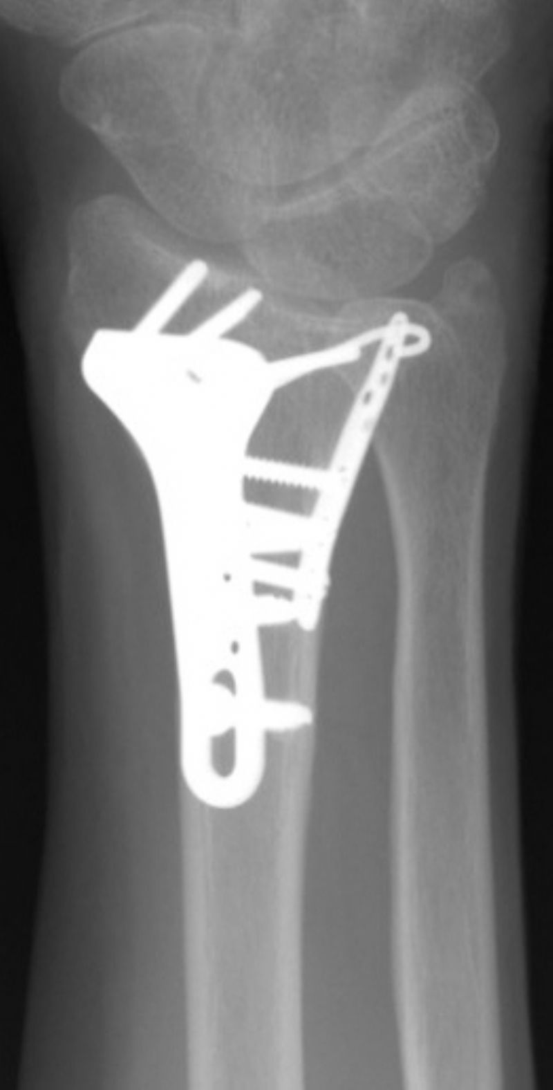 Radius, Distal:  Synthes TriMed (Implant 4267)